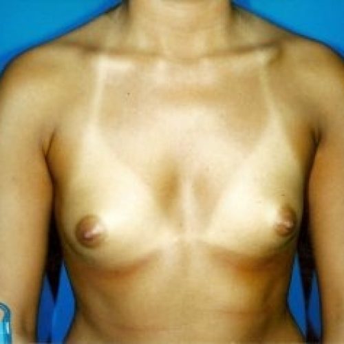 breast1ftv1